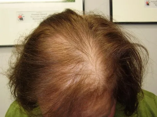 LA Labs Hair Pro bedekt dunner wordend/kaal haar - Donkerblond