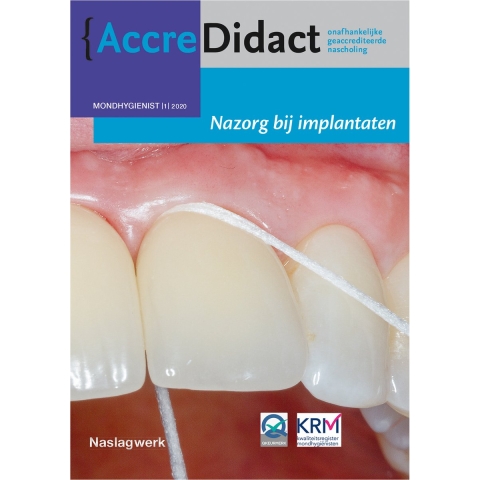 Nazorg bij implantaten (Paperback)