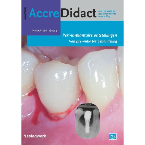 Peri-implantaire ontstekingen (Paperback)